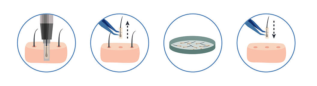 la greffe de cheveux FUE remplace la méthode FUT à partir des années 90