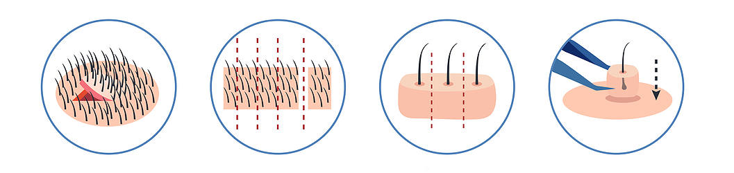 la methode fut est l'une des premieres techniques utilisee dans l'histoire de la greffe de cheveux