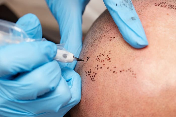 la micropigmentation