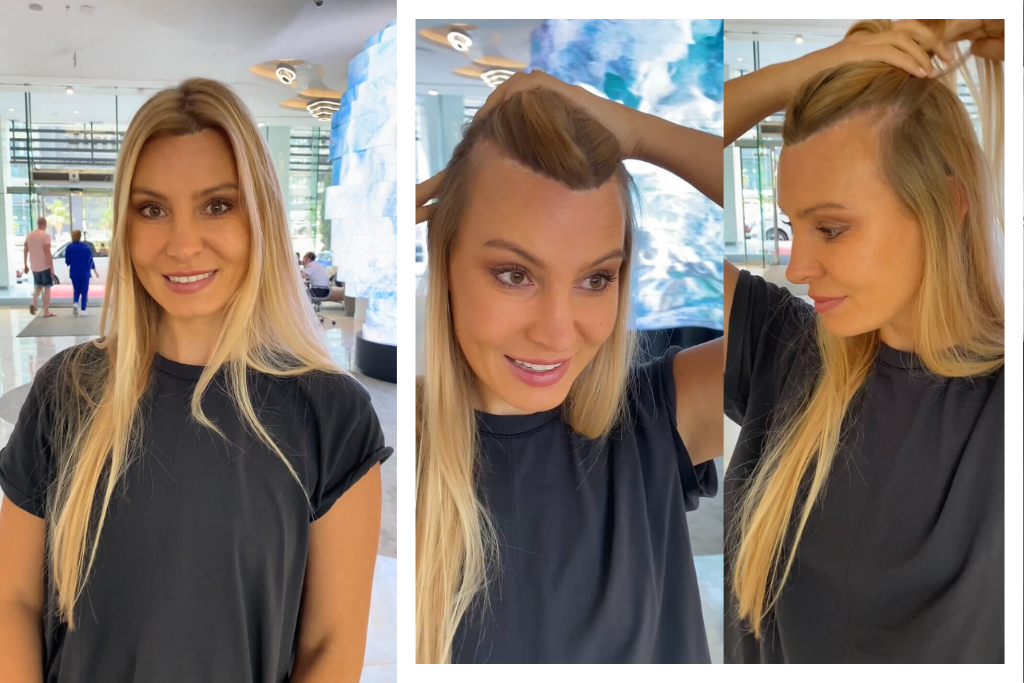 Une patiente Elithair qui va faire une greffe de cheveux contre sa perte de cheveux