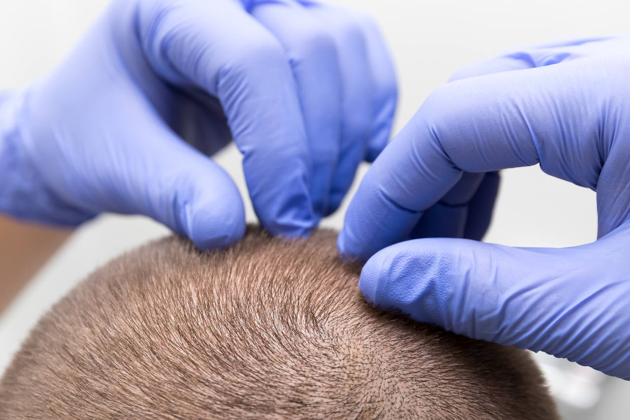 est-il possible d'accélerer la croissance des cheveux apres une greffe