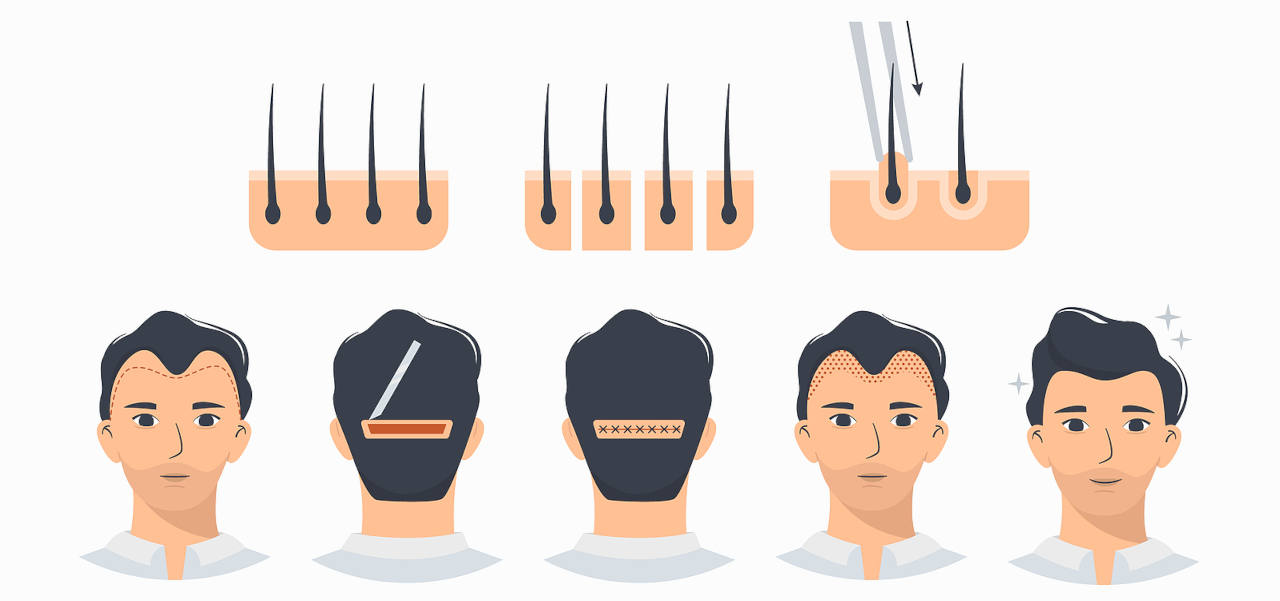 greffe de cheveux inconvenients et avantages de la technique FUT