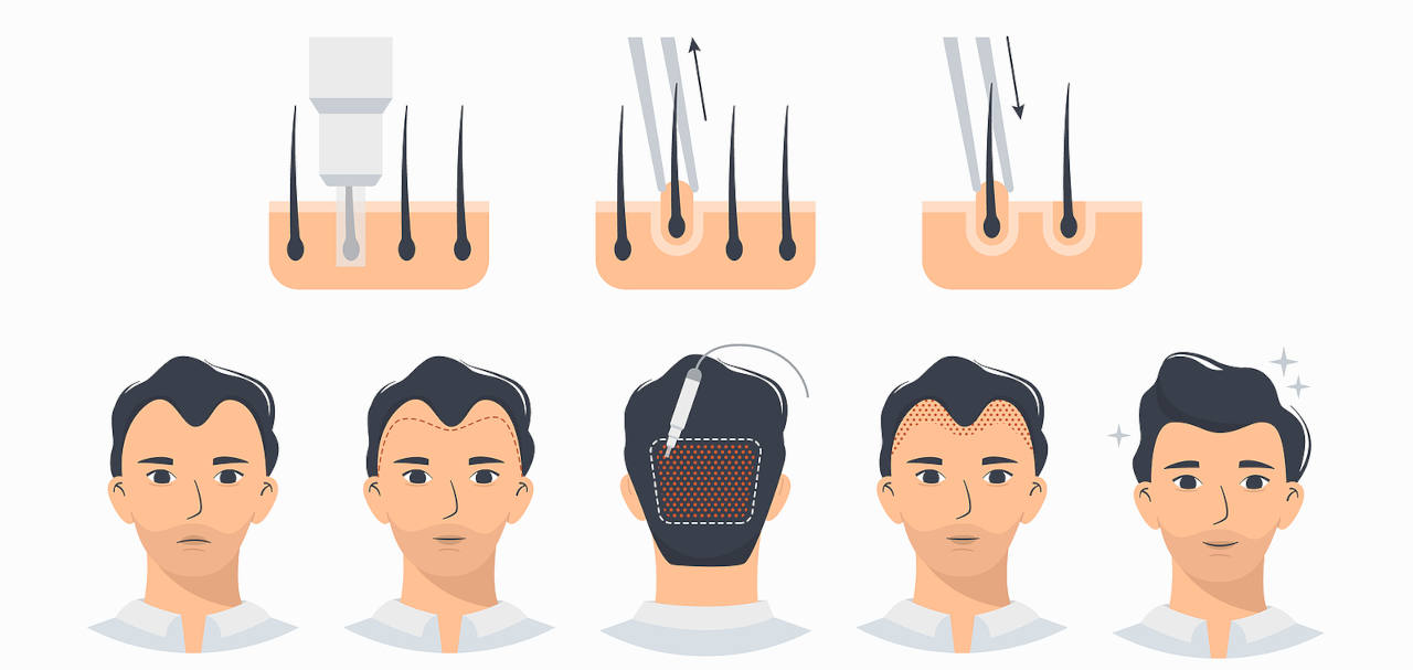 greffe de cheveux inconvenients et avantages de la technique FUE