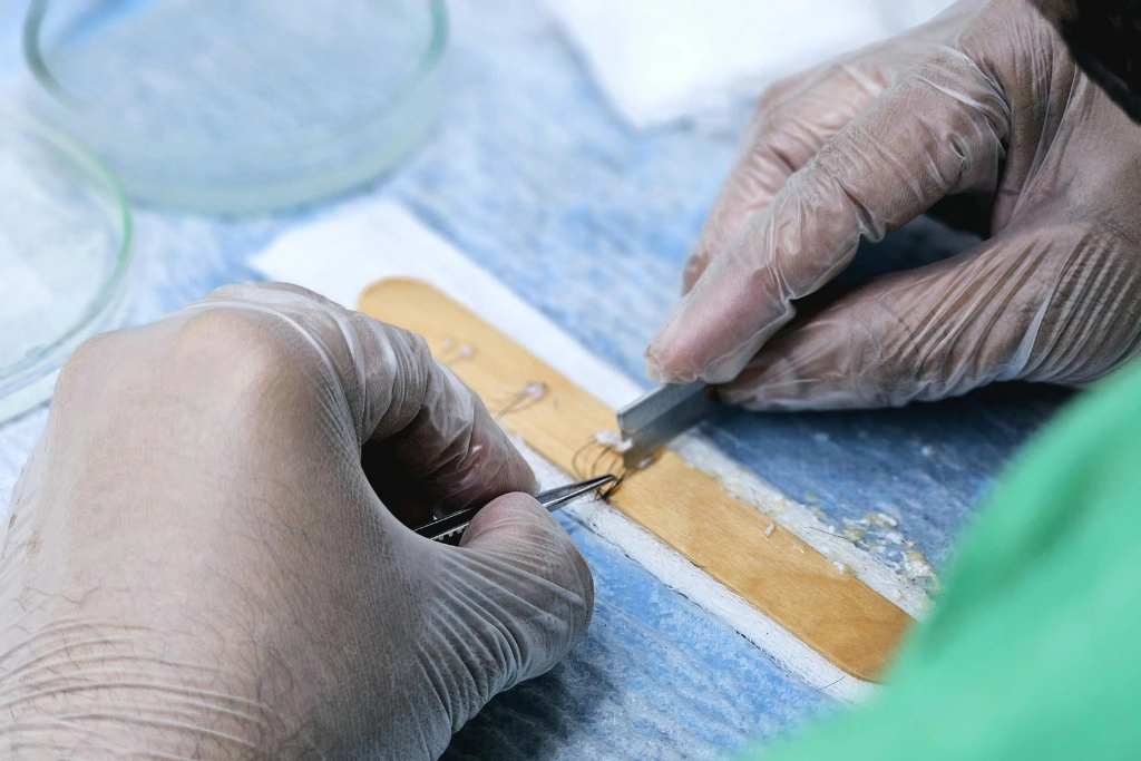Greffons manipulés par un médecin lors d'une intervention d'une greffe de cheveux