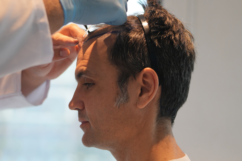 Examen pour le traçage de la nouvelle capillaire d'un patient Elithair