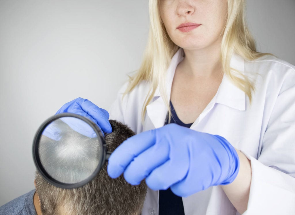 la perte de cheveux unilatérale est une variante rare de la pelade
