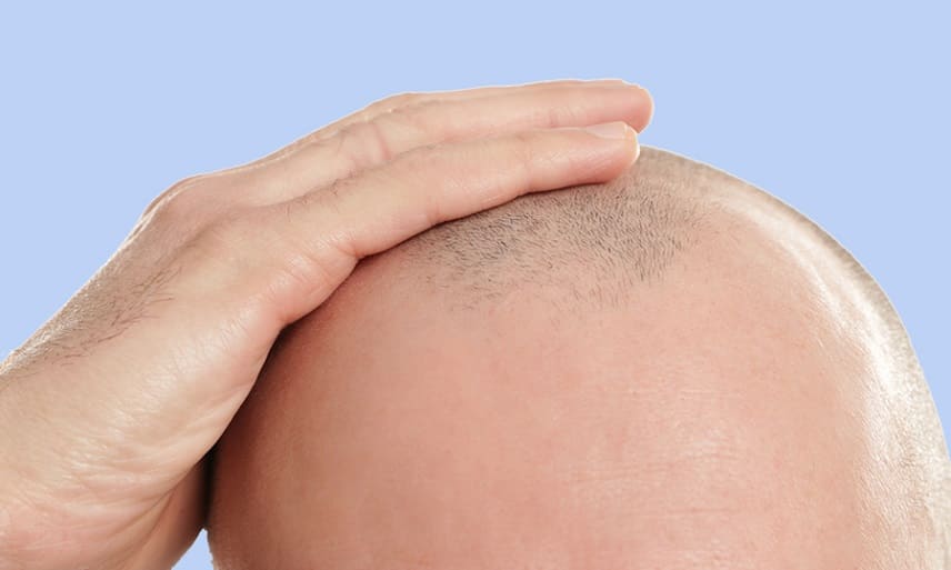 perte de cheveux après une radiothérapie