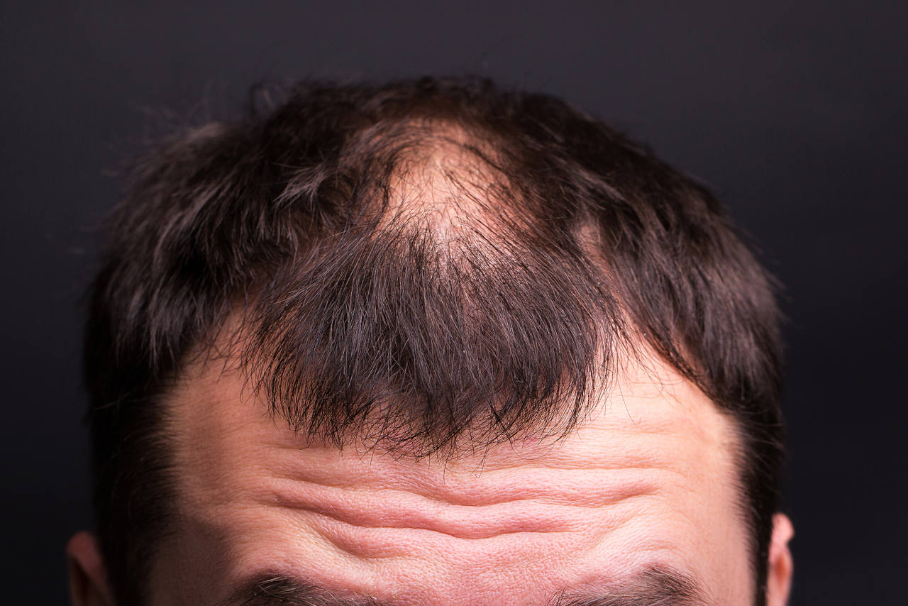 une greffe peut elle faire repousser les cheveux apres une radiotherapie