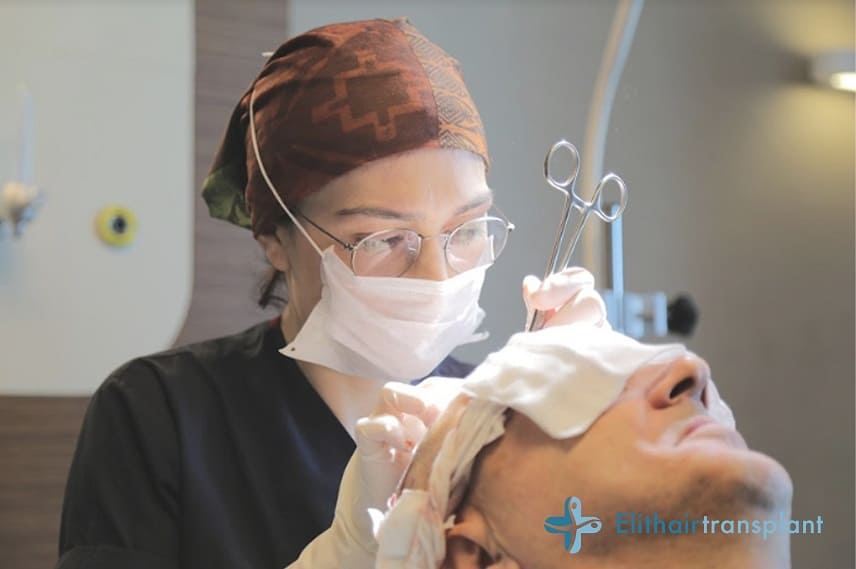 greffe de cheveux anesthésie générale ou locale