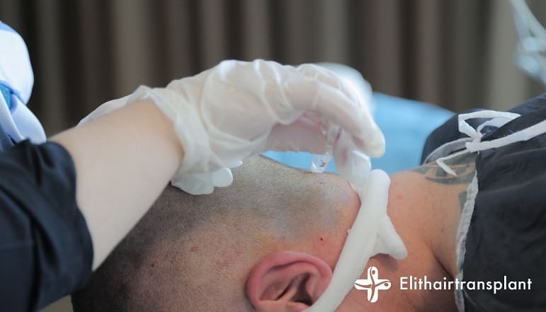 intervention sous anesthesie generale