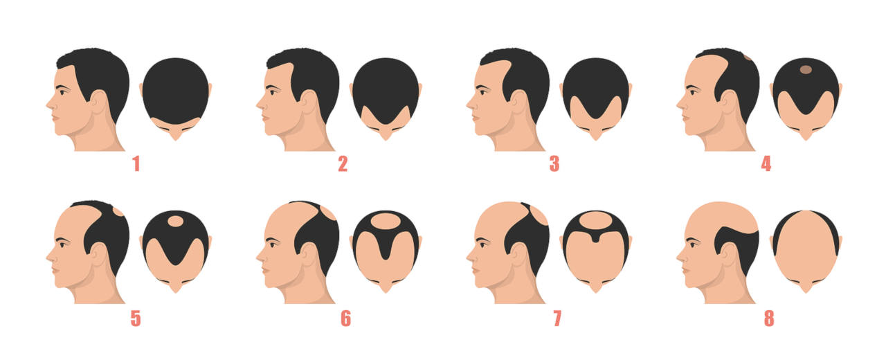 infographie de l’échelle de Norwood Hamilton, permettant de suivre l’évolution de la calvitie héréditaire chez l’homme