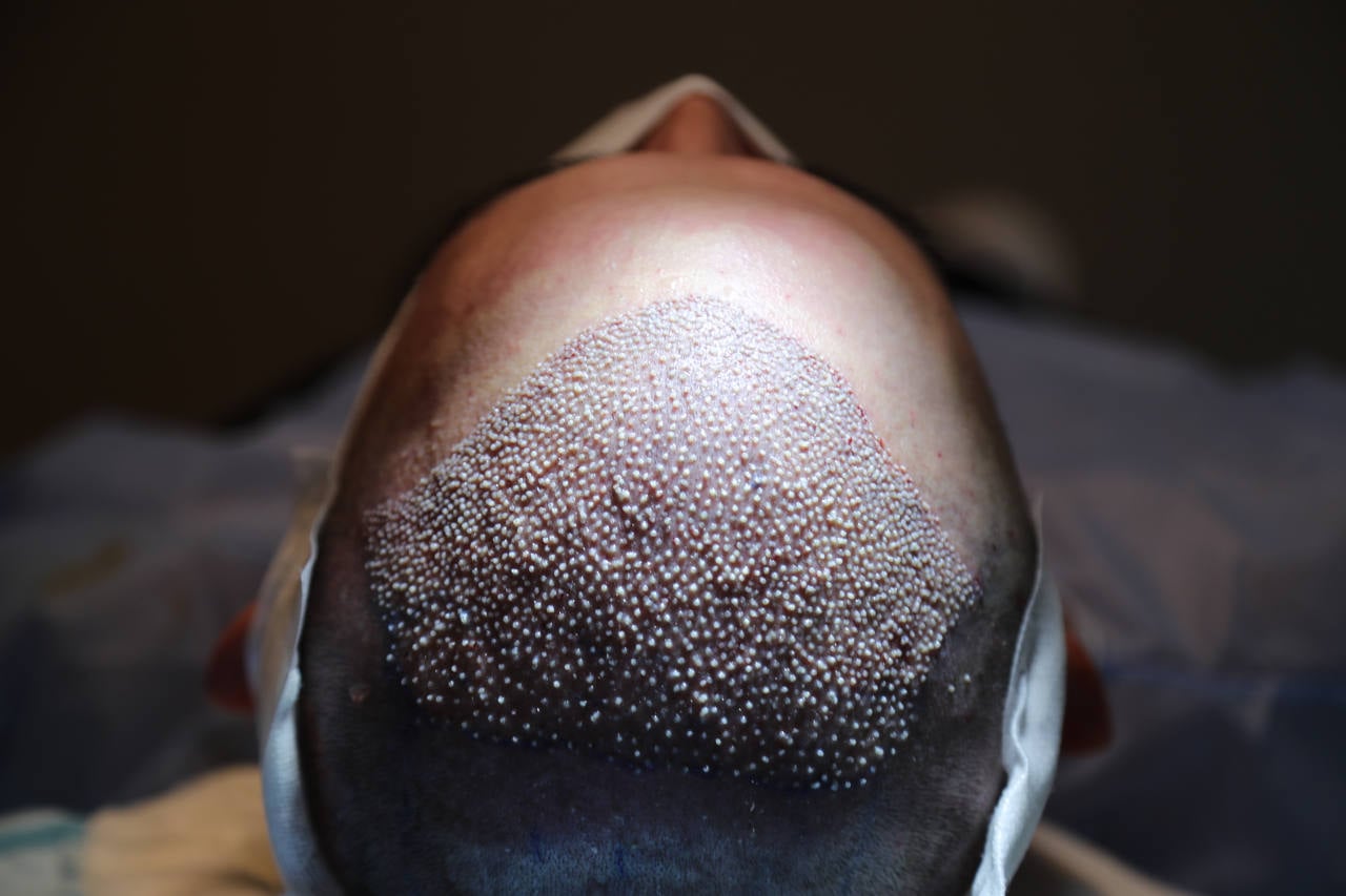 les greffons cheveux sont extraits de la nuque et implantés sur les zones chauves du crane