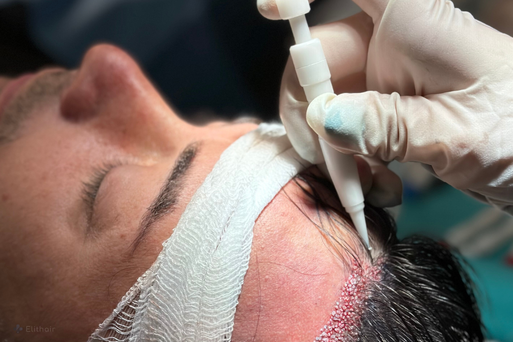 La Turquie est devenue la référence du tourisme médical dans le secteur de la greffe de cheveux