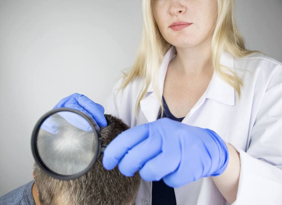 la perte de cheveux unilatérale est une variante rare de la pelade