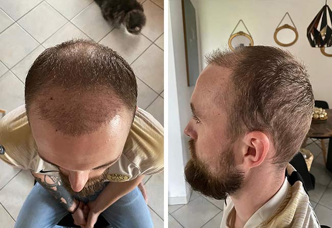Image après 2 mois greffe de cheveux fue saphir 3700 greffons Frederik G
