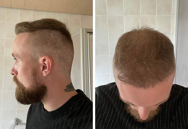 Image après 6 mois greffe de cheveux fue saphir 3700 greffons Frederik G