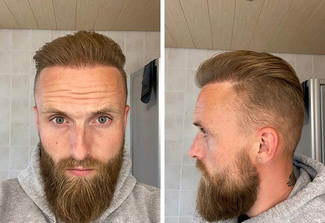 Image après 8 mois greffe de cheveux fue saphir 3700 greffons Frederik G