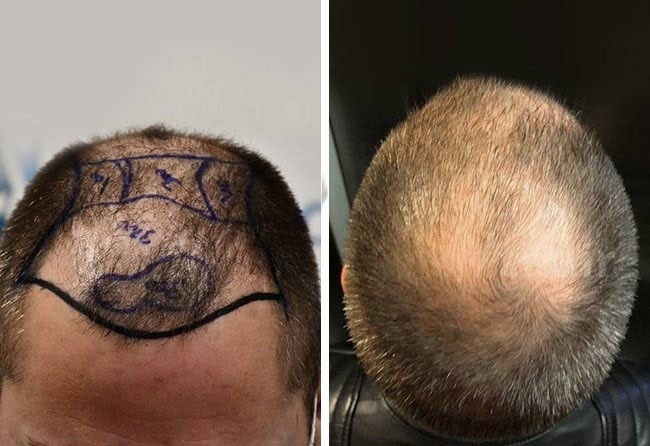 Avant-greffe-de-cheveux-DHI-5200-greffons-andre-o