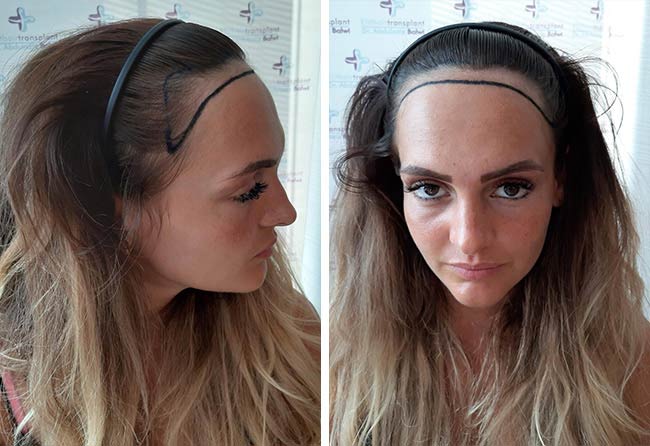 Image apres greffe de cheveux saphir 2200 greffons Karin Baumann