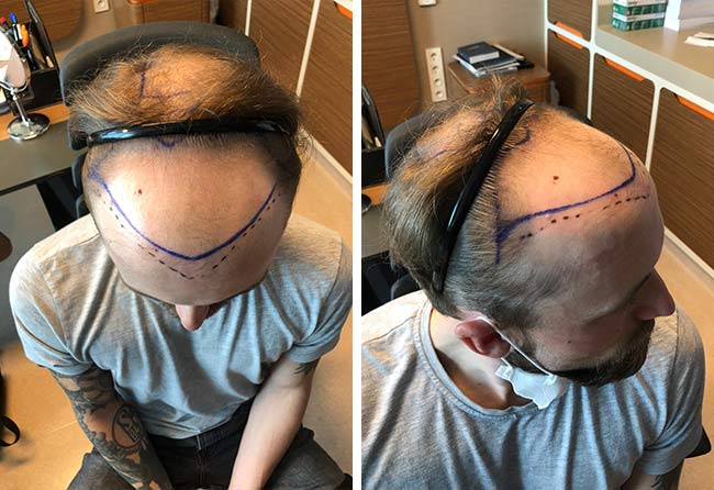 Image avant greffe de cheveux fue saphir 3700 greffons Frederik G