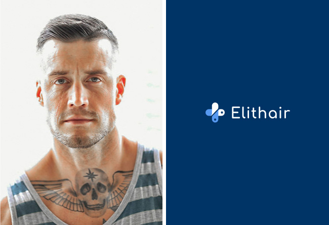 Avant-implant-de-barbe-saphir-4200-greffons-Jhaki