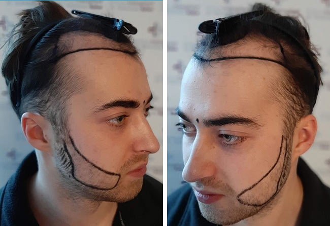 Image avant implant de barbe saphir 4250 greffons Andre Ulbrich