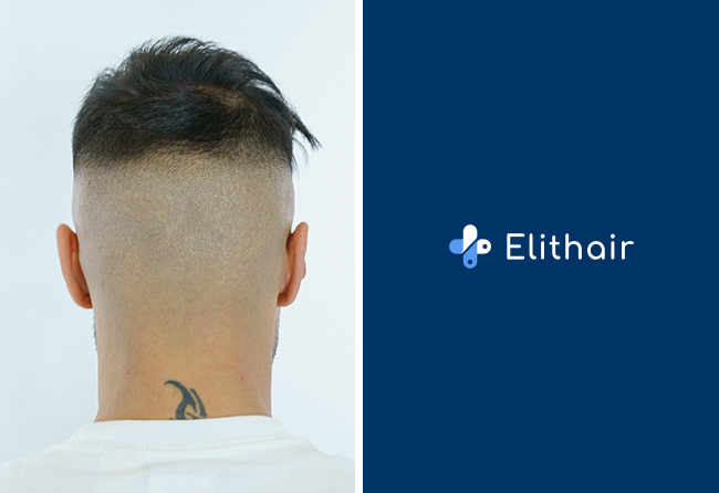 Greffe-de-cheveux-fue-saphir-zone-donneuse-apres-resultat-Osmani-p