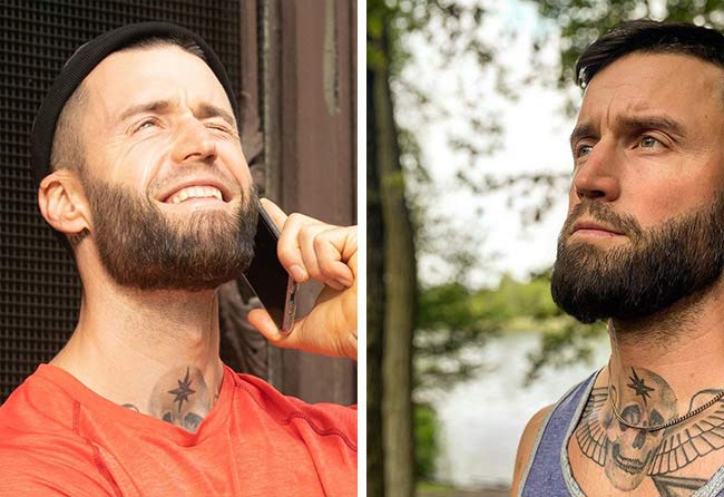 Image resultat implant de barbe saphir 4200 greffons Jahki Schuricht