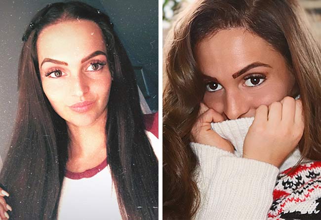 Image resultat greffe de cheveux saphir 2200 greffons Karin Baumann