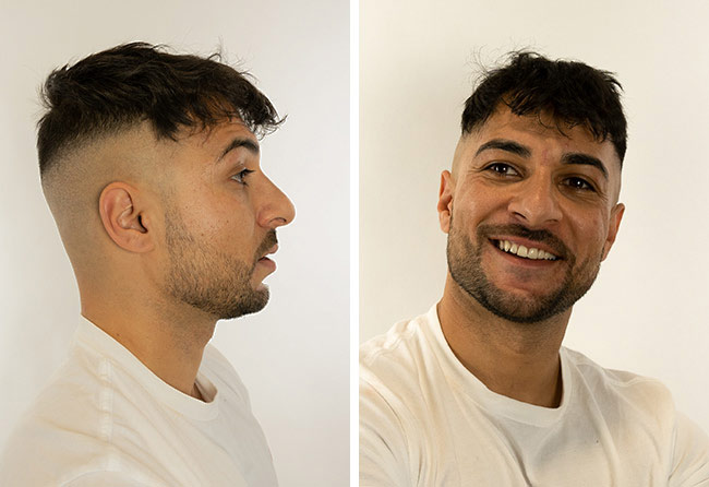 Image resultat greffe de cheveux saphir 2200 greffons Osamani Perparim