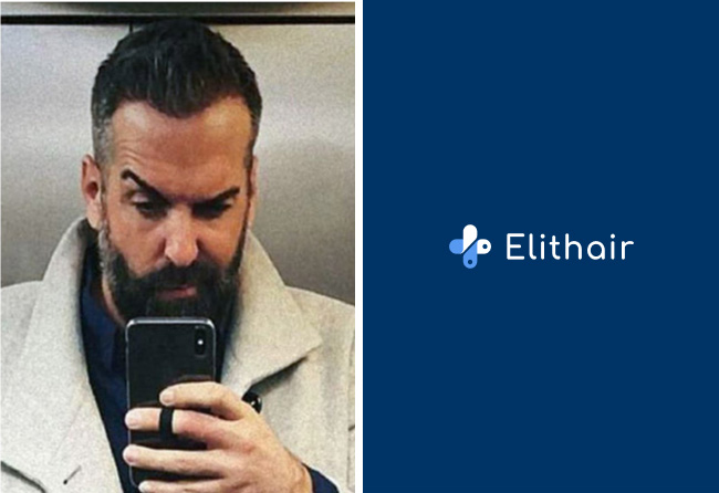 Resultat-greffe-de-cheveux-saphir-3400-greffons-Juergen-T