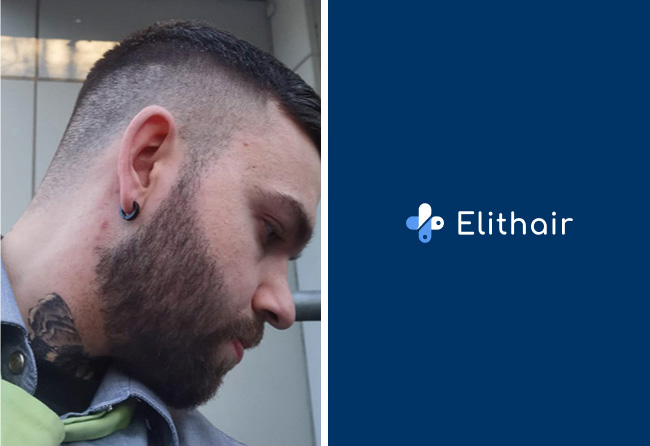 Resultat-implant-de-barbe-saphir-2700-greffons-Nico-M