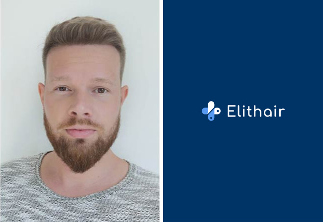 apres-greffe-de-cheveux-saphir-2800-greffons-alexander-k.