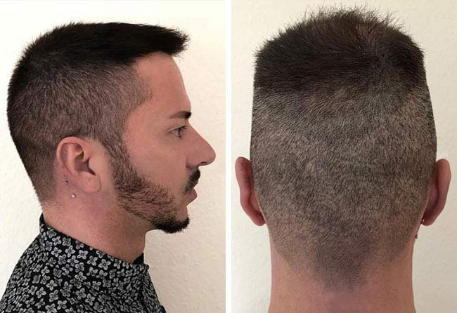 resultat-greffe-de-cheveux-DHI-5200-greffons-andre-o