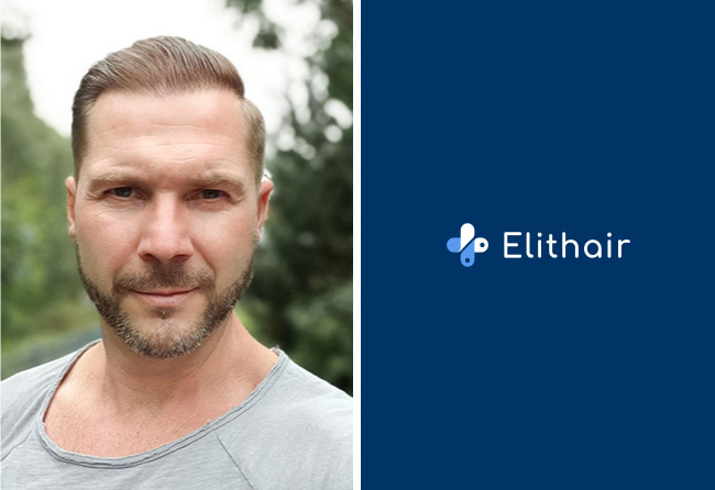 Image resultat greffe de cheveux saphir 4100 greffons Markus