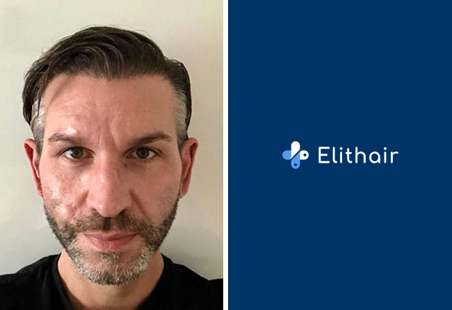 resultat-greffe-de-cheveux-fue-saphir-4250-greffons-Thomas-s