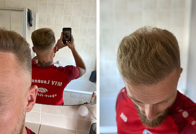 Photo résultat greffe de cheveux saphir tonsure 4700 Frederic Gigers