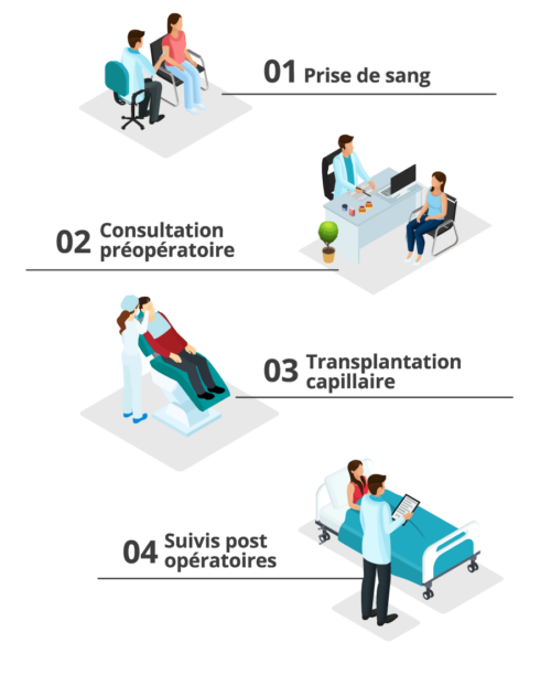 Illustration en 4 étapes de la procédure de greffe de cheveux en Turquie
