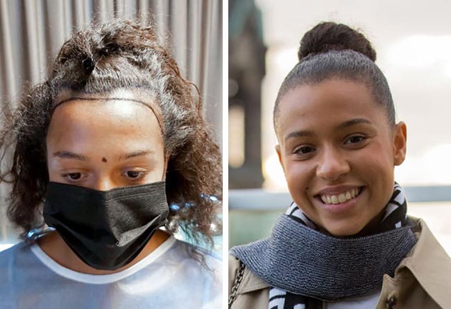 Image avant après greffe de cheveux femme SDHI 2700 greffons Melissa Zerhau