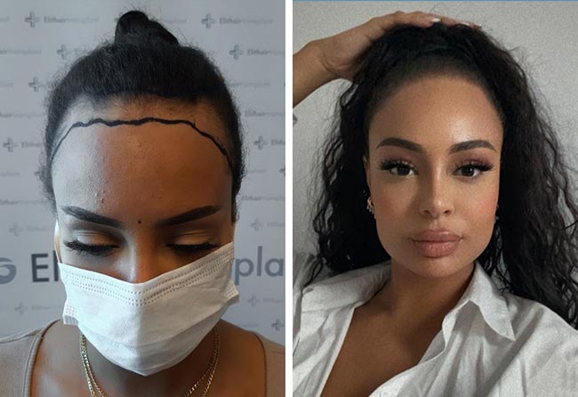 Image avant après greffe de cheveux femme SDHI 3200 greffonsJahy. C