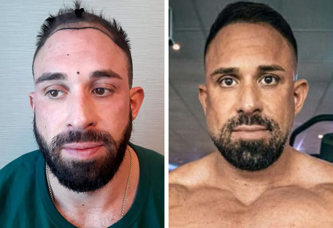 Image avant apres greffe de cheveux saphir 2700 greffons Kevin Wolter