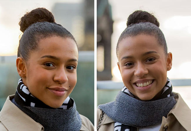 Image resultat greffe de cheveux femme SDHI 2700 greffons Melissa Zerhau