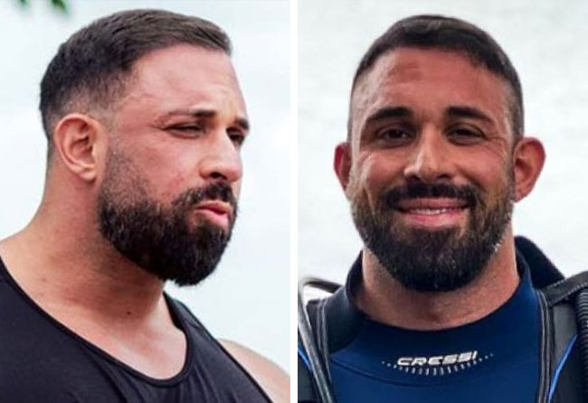 Image resultat greffe de cheveux saphir 2700 greffons Kevin Wolter