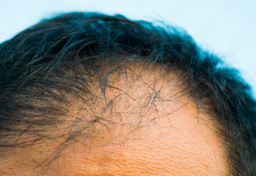 patient souffrant d'un début d'alopécie