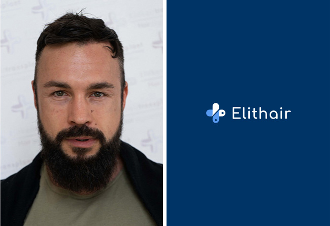 Après-greffe-de-cheveux-fue-saphir-2200-greffons-Road-to-Glory