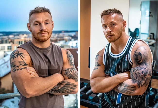 Image apres greffe de cheveux fue saphir 3100 greffons Coach Stef