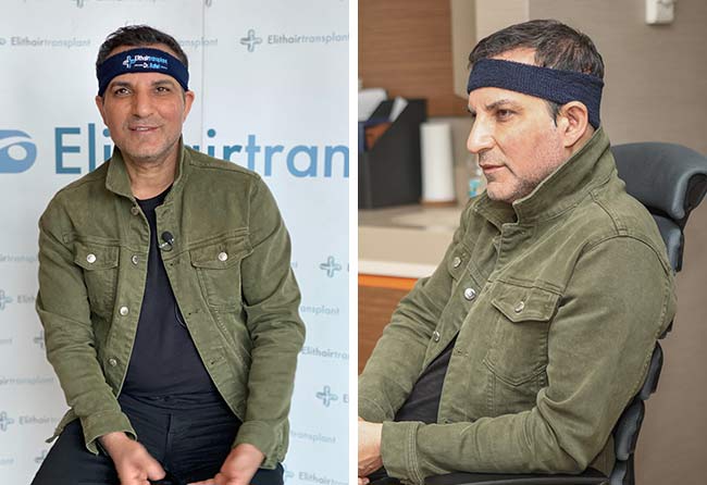 Image avant greffe capillaire 2600 greffons rafet el roman