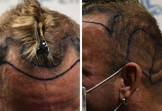 Image avant greffe de cheveux DHI 2900 greffons Hollywood Matze