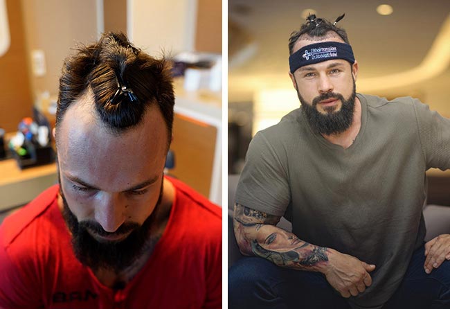 Image avant greffe de cheveux fue saphir 2200 greffons Road to Glory