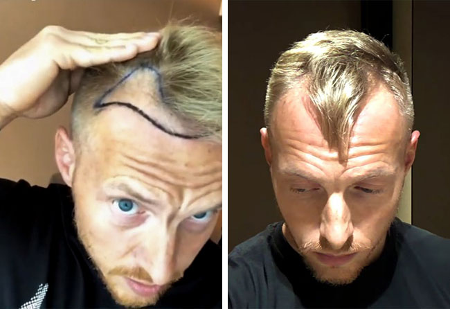 Image avant greffe de cheveux fue saphir 3100 greffons Coach Stef